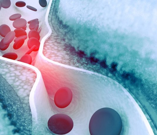 kolesterol belirtileri 