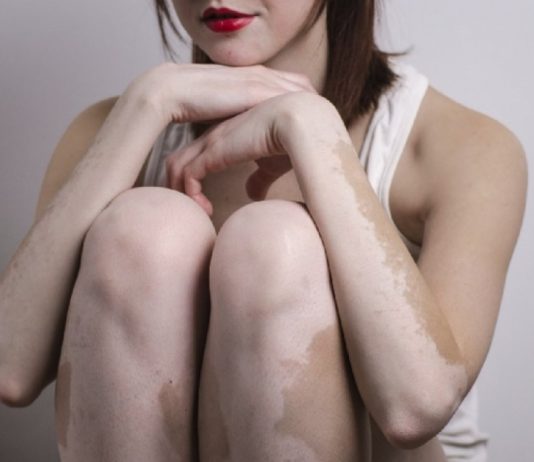 vitiligo