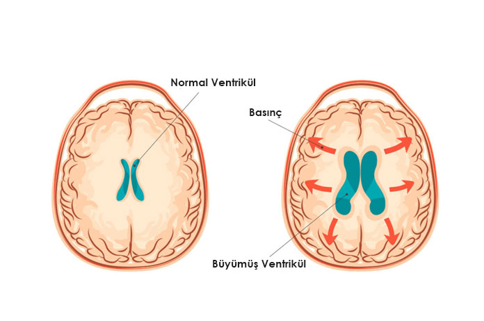 Hidrosefali nedir