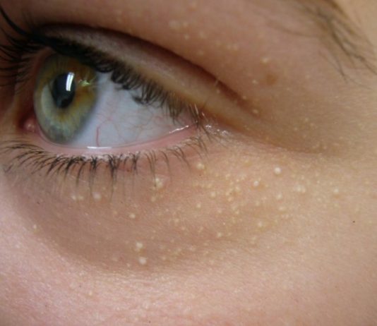 yağ bezesi tedavisi